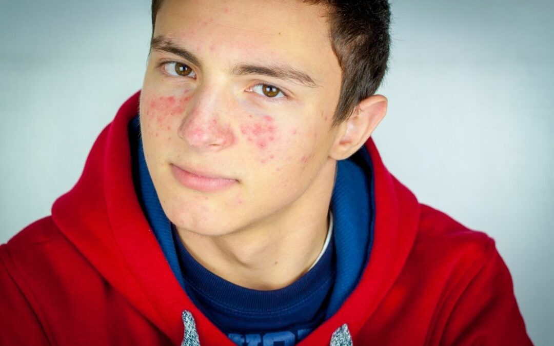 Mara-laser-treatments-for-acne-boy
