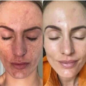 Mara AlumierMD before and after