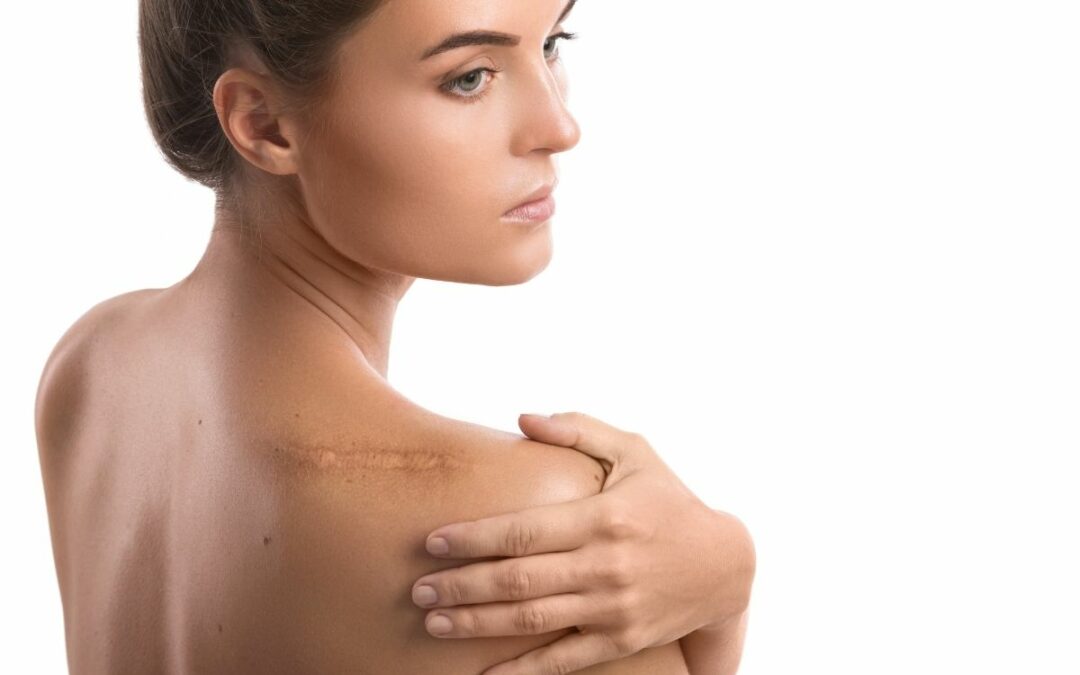 What Are The Best Med Spa Treatments For Scars?