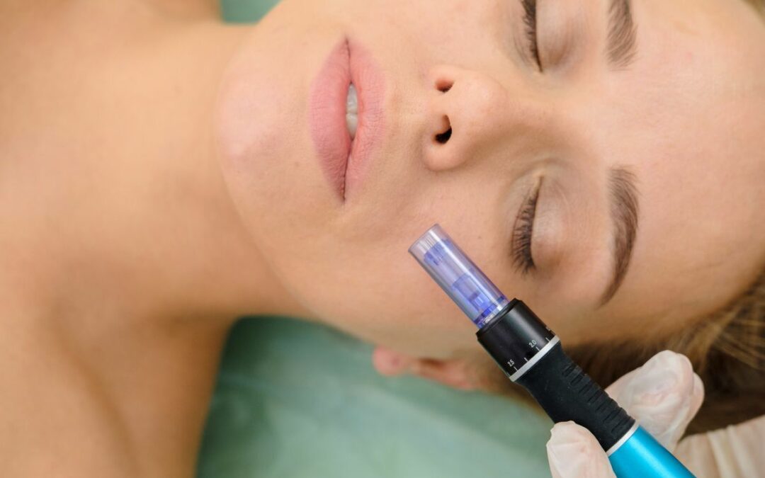 Dallas Microneedling Treatments Are the Popular Choice For Texans Wanting Flawless Skin