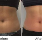 Venus Bliss MAX&trade; Treatment