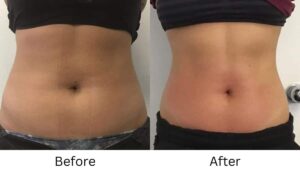 Venus Bliss MAX&trade; Treatment