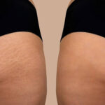 Laser Stretch Mark Removal Dallas, TX