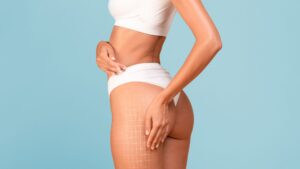 Mara - maximizing your coolsculpting results in Dallas