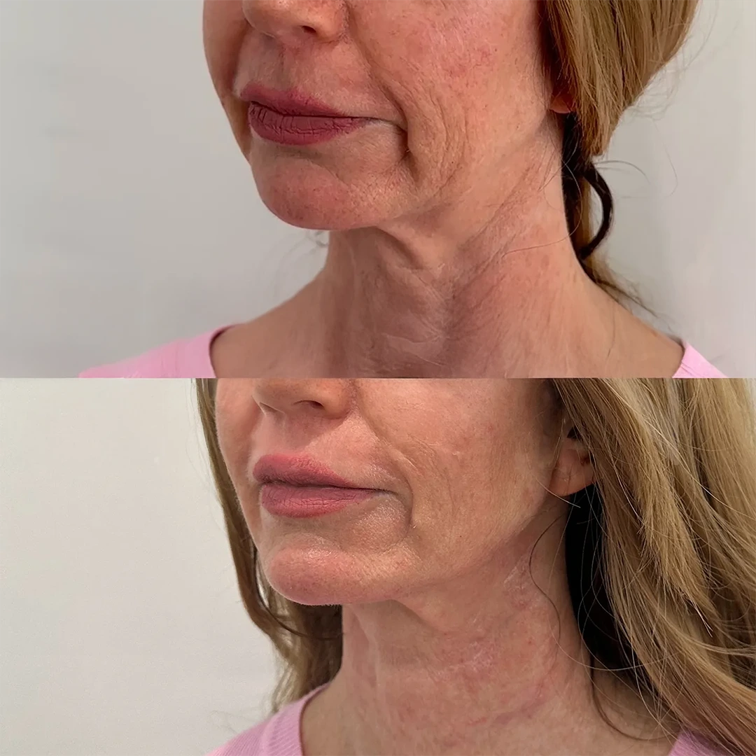 thread lift in dallas &mdash; before and after using PDO mono threads to lift the midface and jawline for a refined Non-Surgical Facelift effect