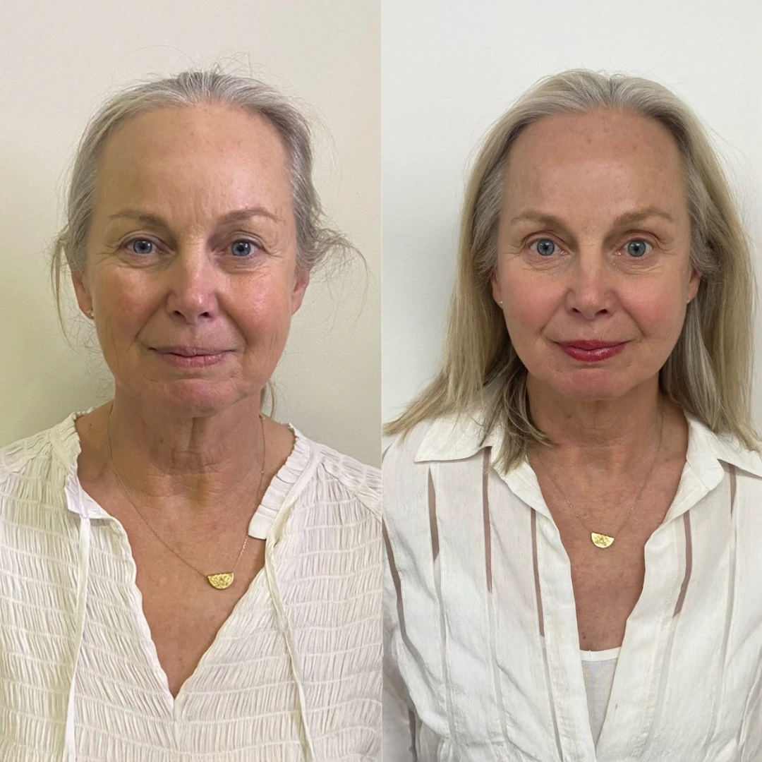 mono thread lift in dallas &mdash; before and after smoothing and lifting along the lower face with PDO threads for a subtle Non-Surgical Facelift result
