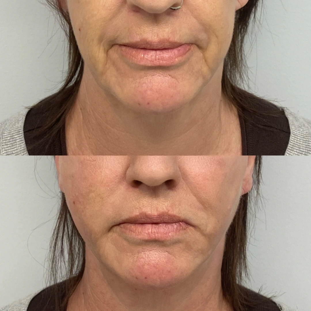 pdo threads lift in dallas &mdash; before and after showing cheek and nasolabial support with PDO mono threads for a Non-Surgical Facelift look