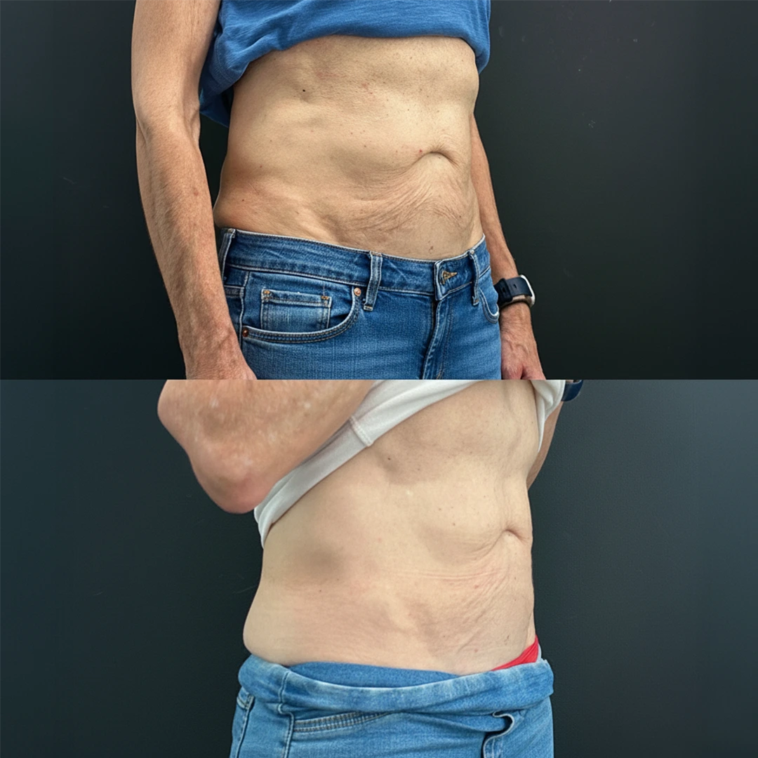 HeatWave Therapy in dallas before and after pictures showing abdomen tightening with visibly smoother midsection