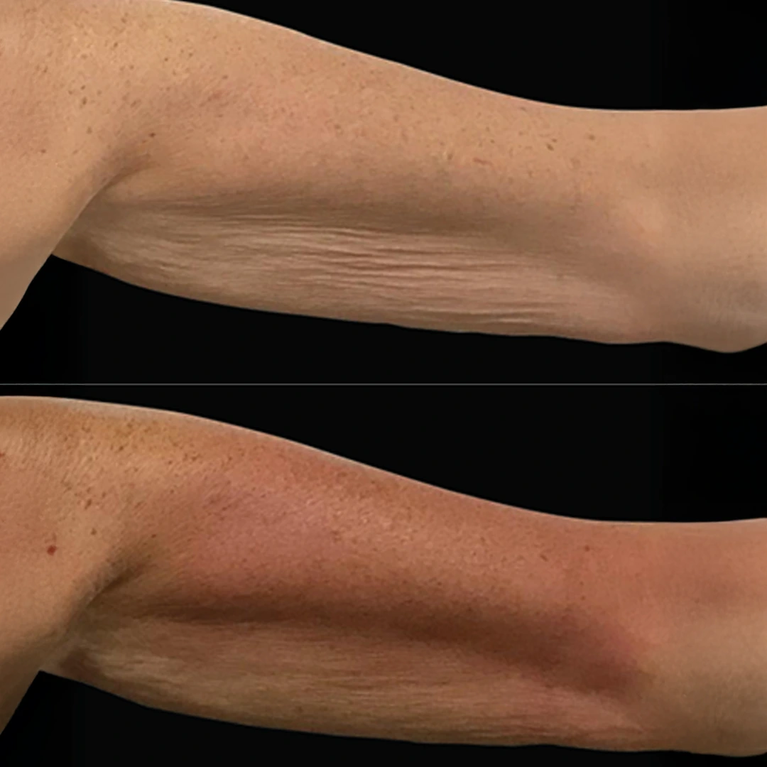 HeatWave before and after &mdash; underarms (upper arms) with refined contour and lift