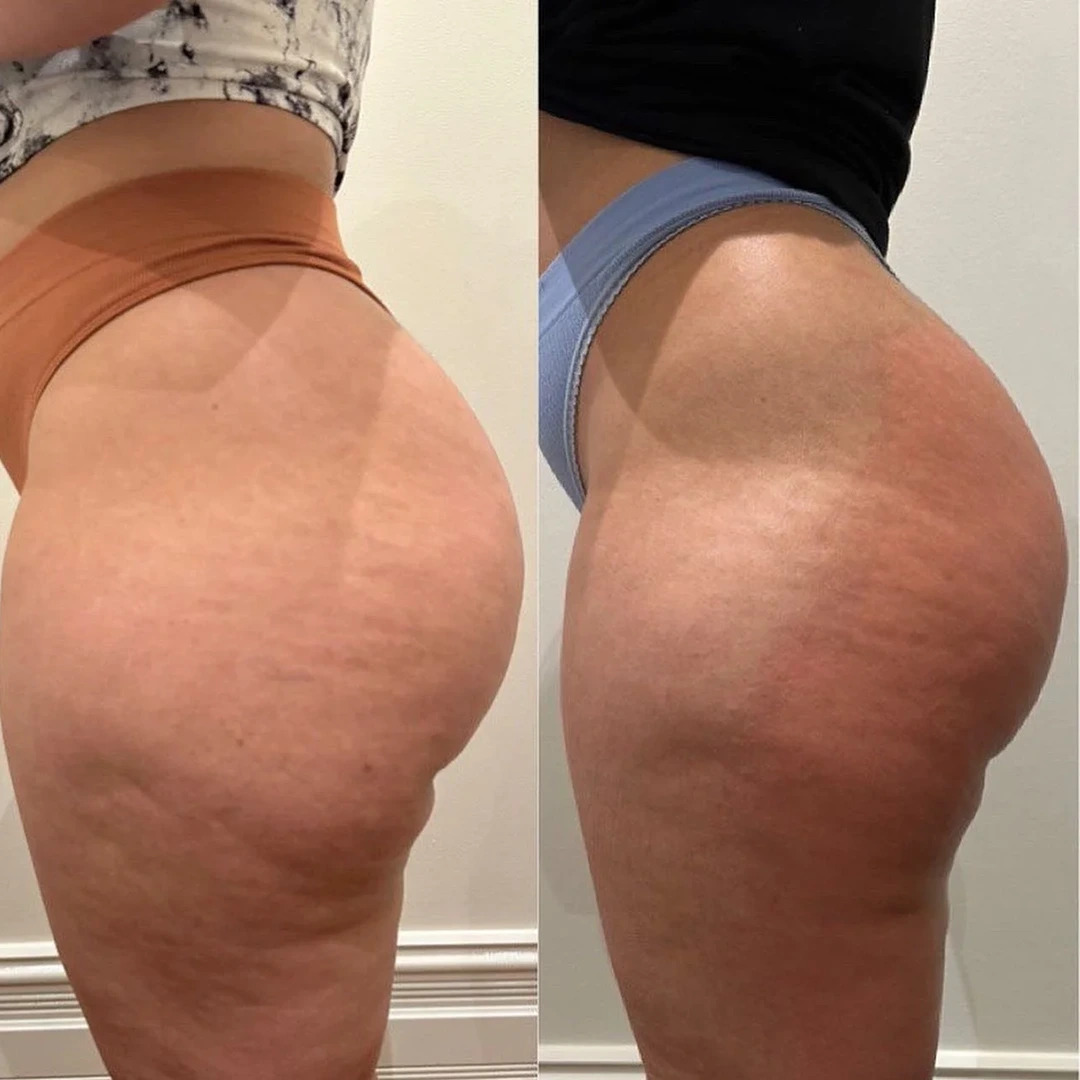 HeatWave before and after &mdash; back of thighs smoothing and firmer contour