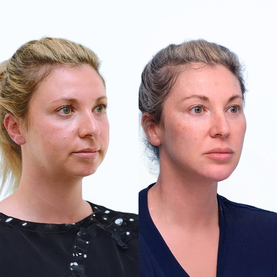 Juvéderm in Dallas — before and after softening of smile lines and marionette lines