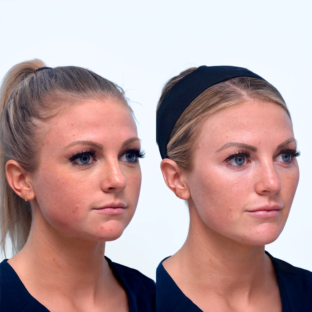 Juvéderm in Dallas — before and after cheek and jawline contouring with natural lift and definition