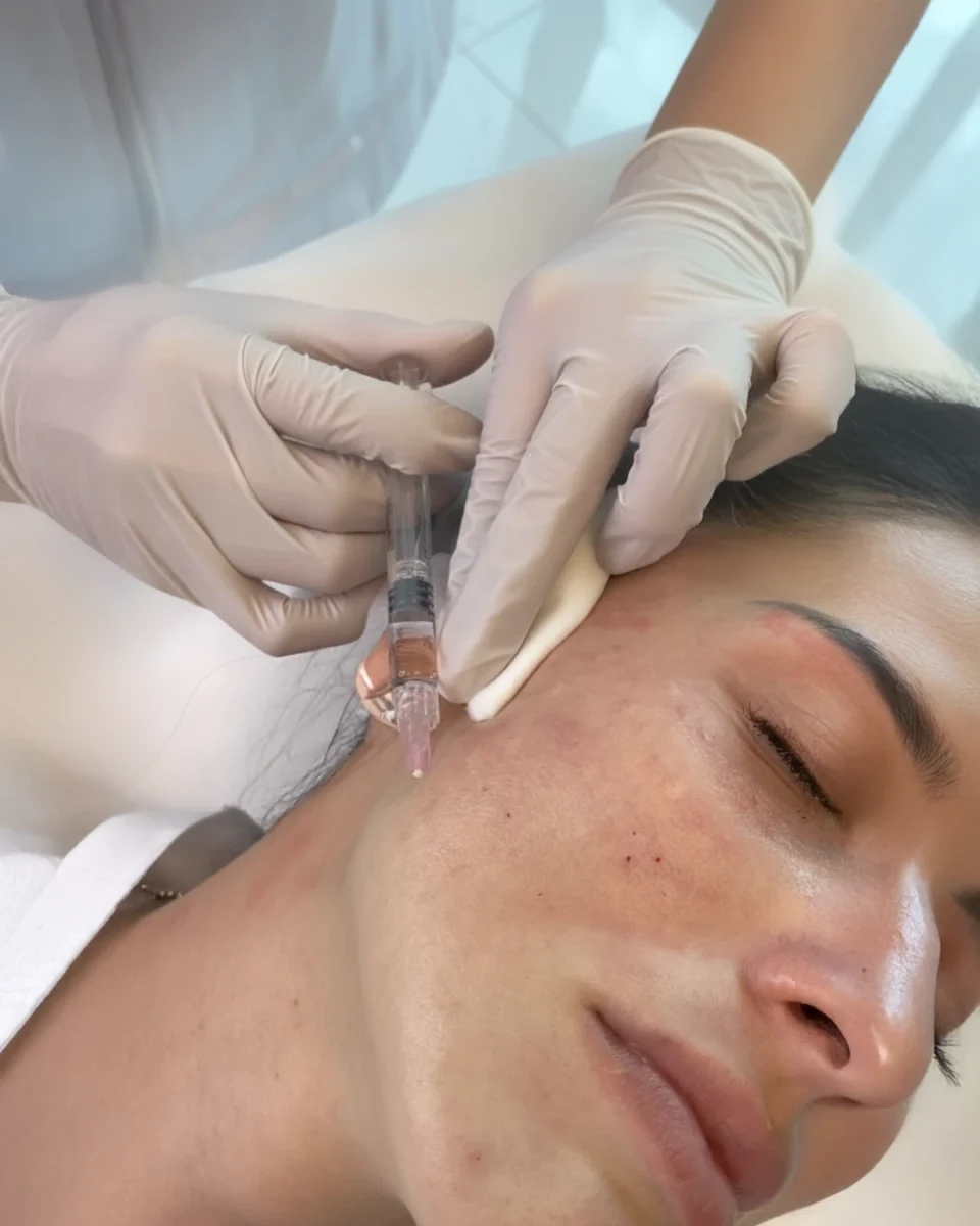 Juvéderm Skinvive microdroplet skin booster for lasting glow in Dallas