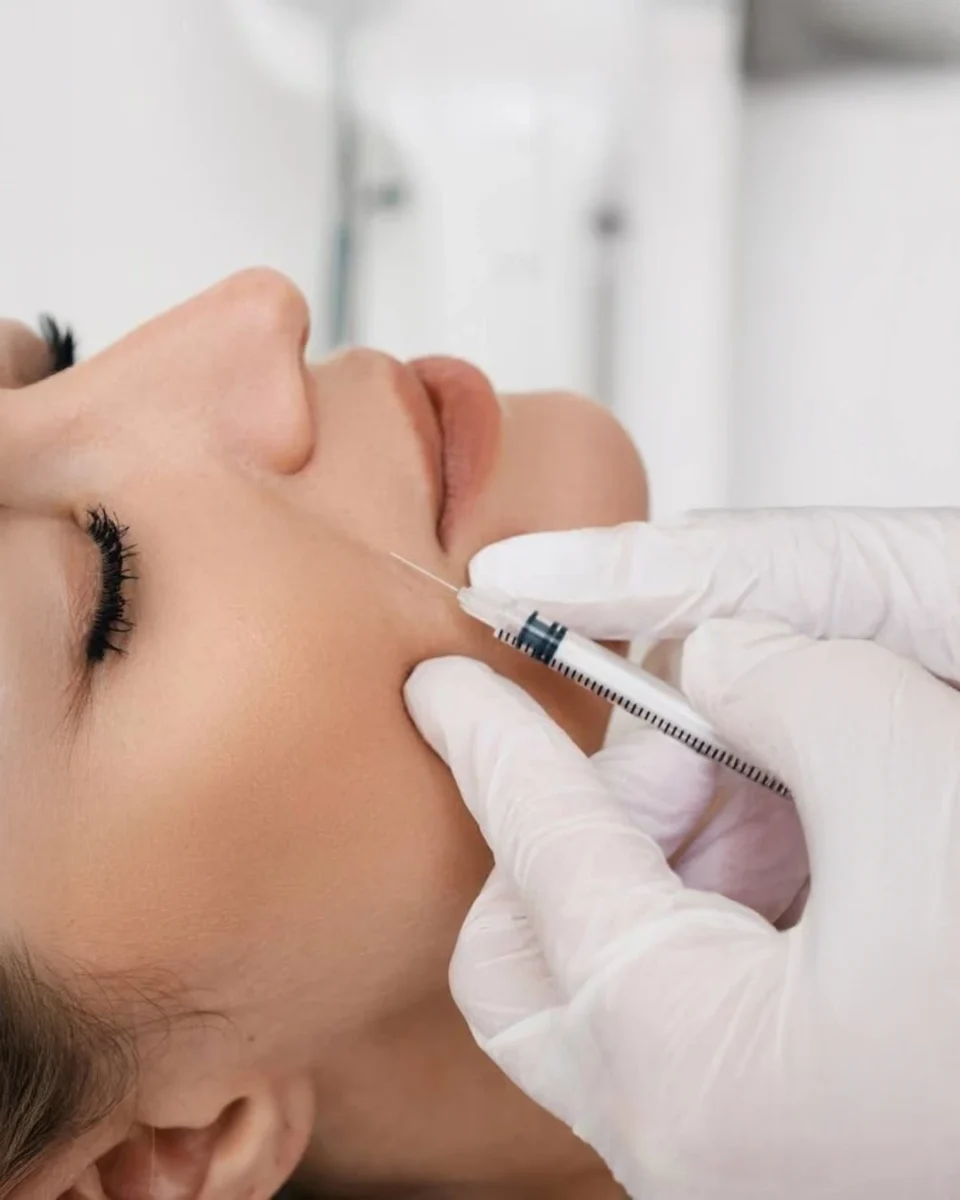 Juvéderm Vollure filler to soften smile lines with flexible support in Dallas