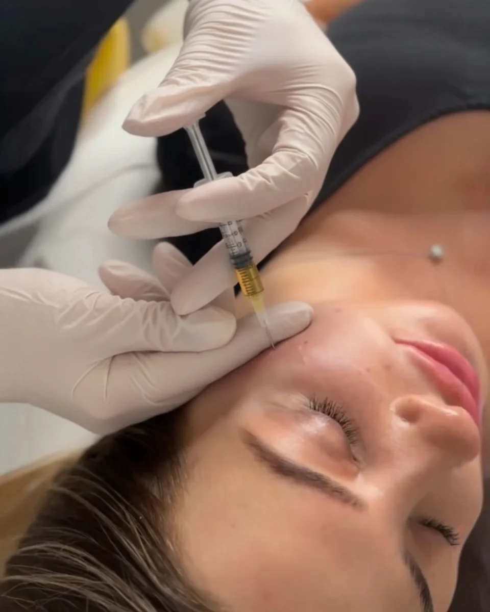 Juvéderm Voluma cheek filler to lift and contour midface at Mara's Med Spa Dallas