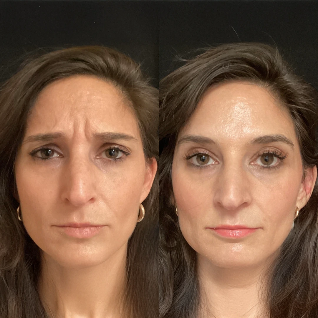 Letybo Wrinkle Relaxer Dallas &mdash; before and after refining forehead lines with natural movement (female)