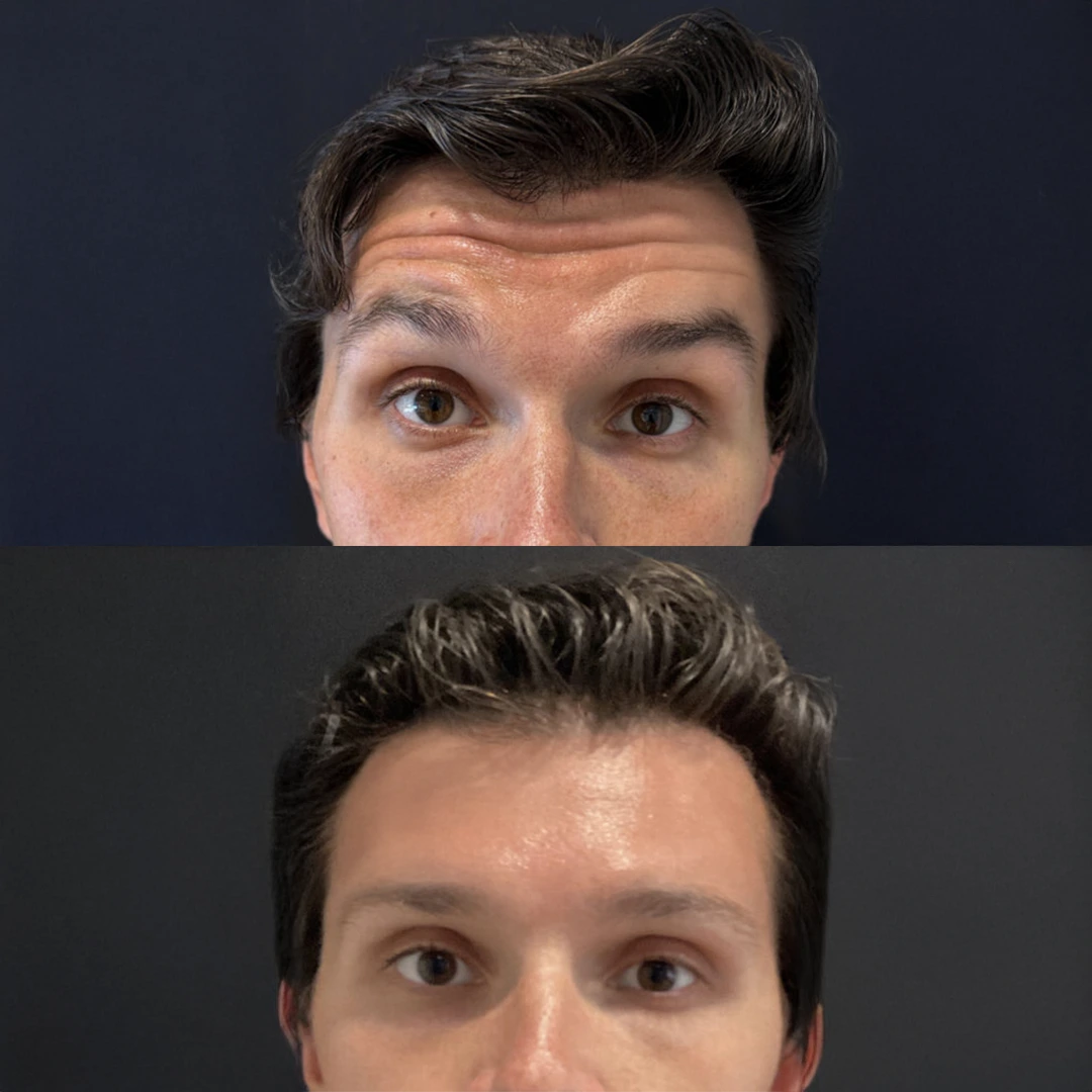 Botox Alternatives in Dallas &mdash; Letybo before and after softening forehead and frown lines (male)