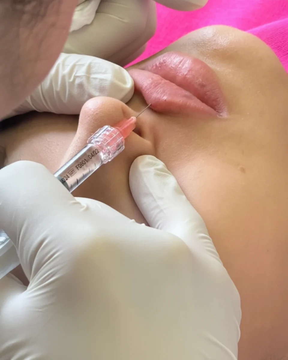 Restylane Kysse lip filler for soft, flexible volume in Dallas