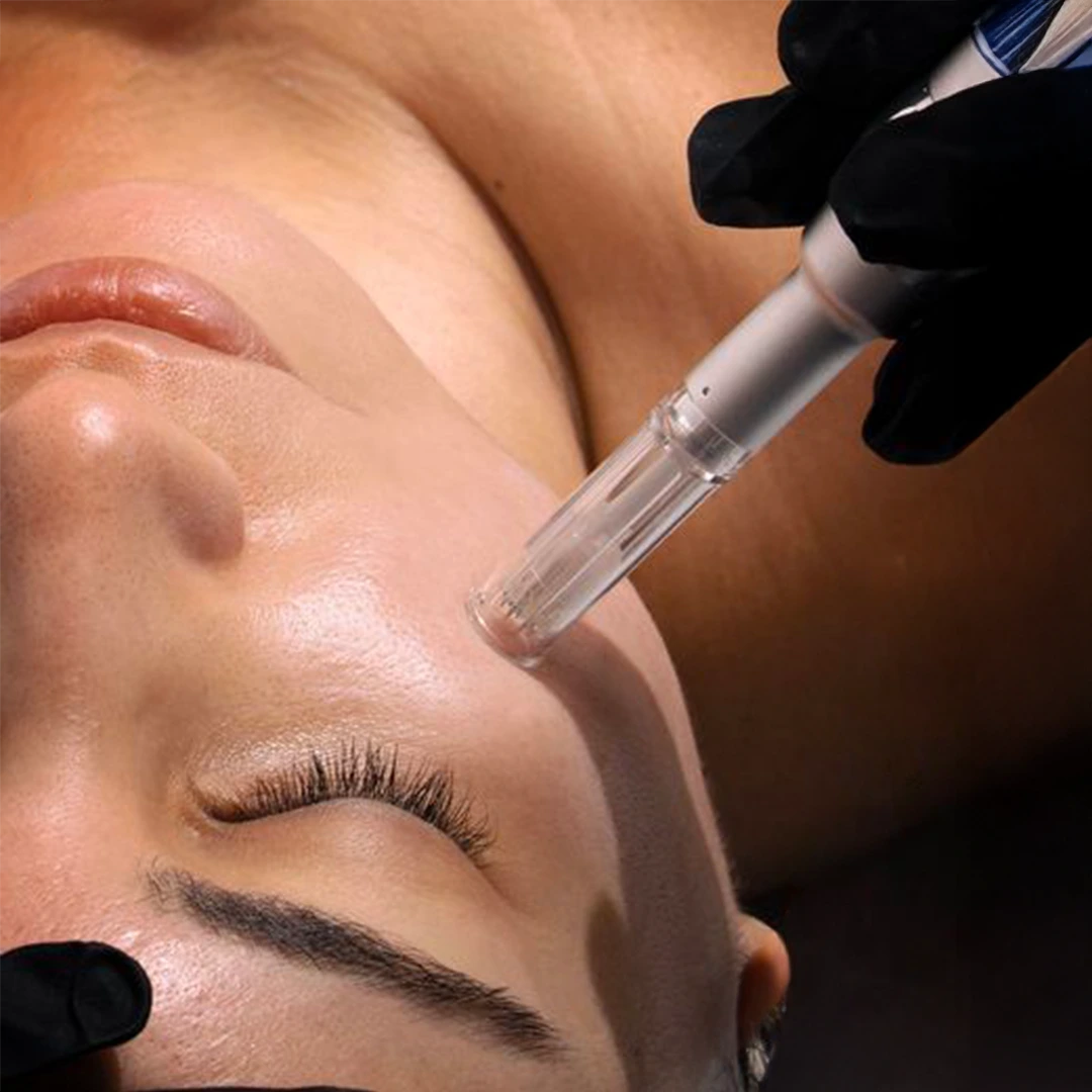 Radiance Reset microneedling and peel results