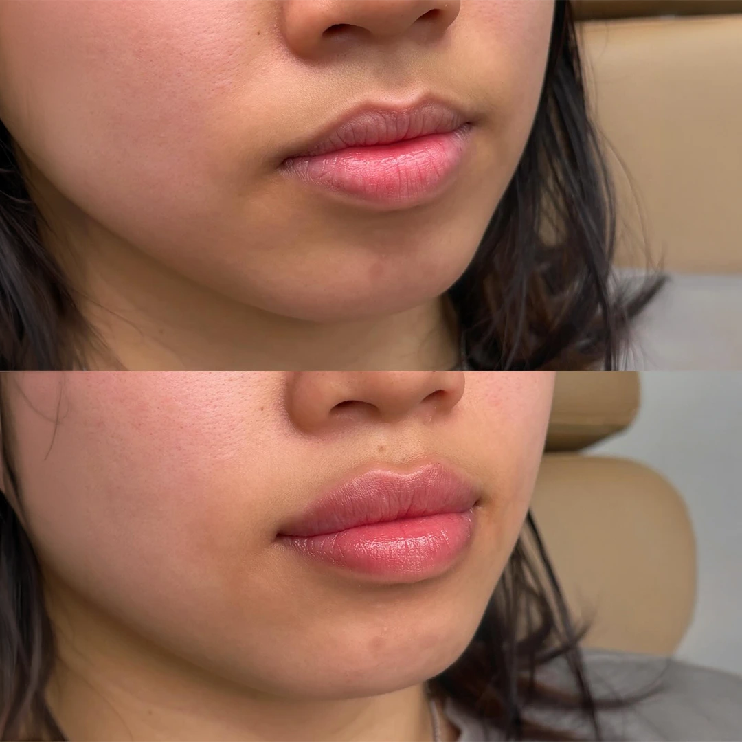 Lumi Lips results — smoother, softer-looking lips with improved hydration and natural lip refinement
