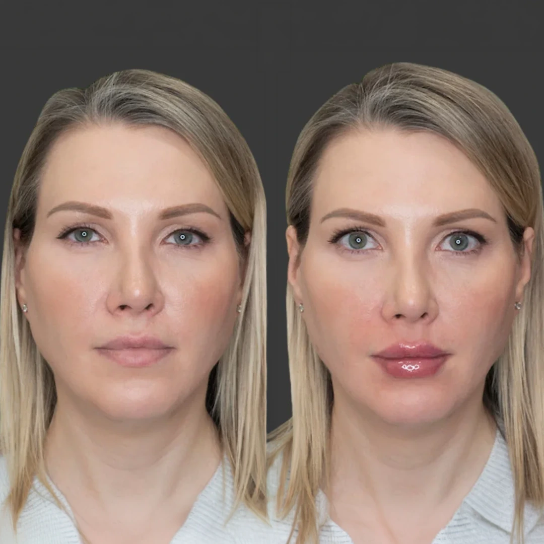 Lumi Lips in Dallas — hydrated-looking lips with smoother texture and a natural refreshed finish