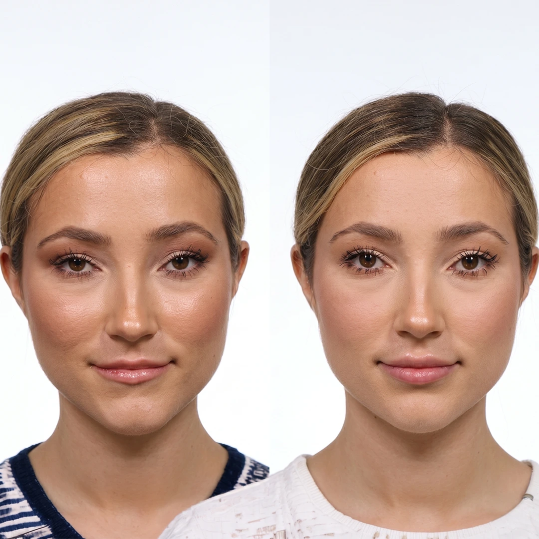 Lumi Lips treatment in Dallas — naturally refreshed lips with improved softness, texture, and hydration